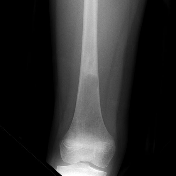 File:Fibrous dysplasia - distal femur (Radiopaedia 8129).jpg