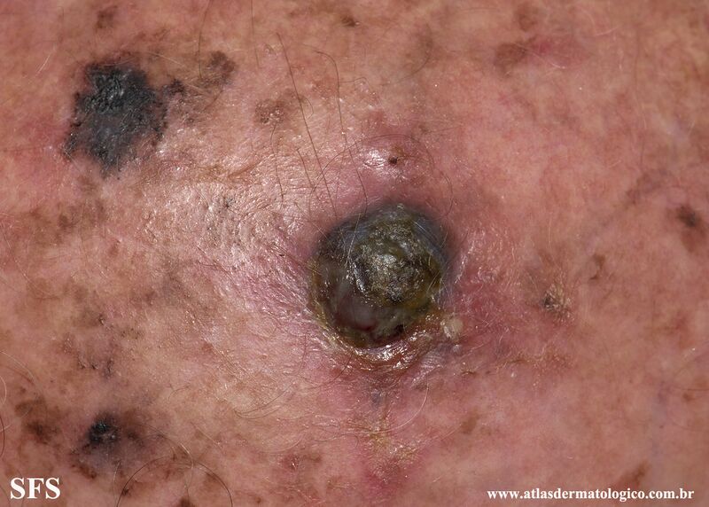 File:Melanoma (Dermatology Atlas 94).jpg
