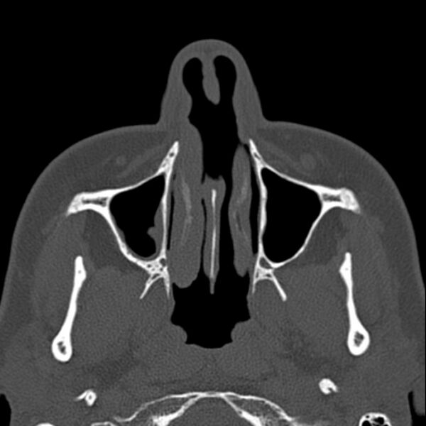 File:Nasal septal perforation (Radiopaedia 25030-25289 Axial bone window 10).jpg