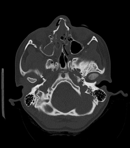 File:Nasoorbitoethmoid fracture (Radiopaedia 90044-107205 Axial bone window 72).jpg