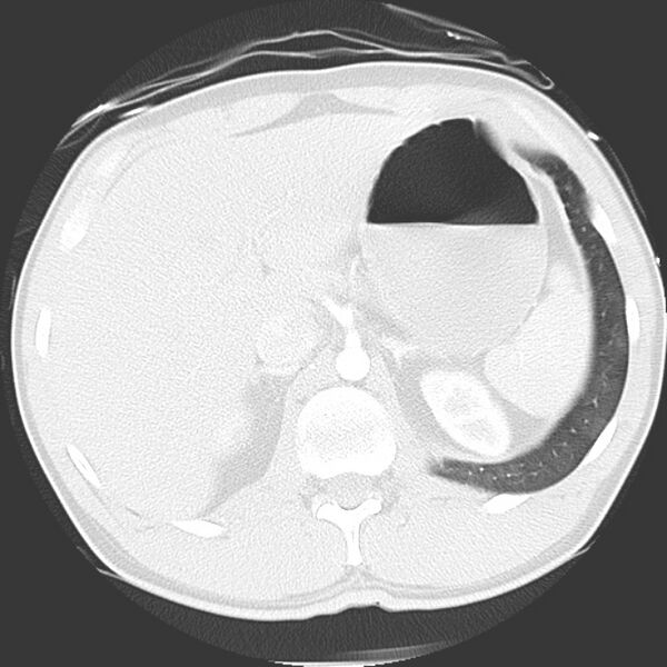 File:Near drowning pulmonary edema (Radiopaedia 16868-16591 Axial lung window 54).jpg