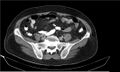 Necrotizing pancreatitis (Radiopaedia 20595-20495 Axial C+ delayed 33).jpg