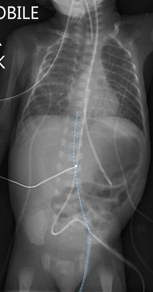 File:Neonatal bowel perforation (Radiopaedia 23839-24000 UVC 1).jpg