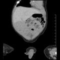 Neonatal neuroblastoma (Radiopaedia 56651-63438 Coronal non-contrast 11).jpg