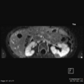 Nephroblastomatosis (Radiopaedia 39984-42478 Axial T1 C+ fat sat 1).png