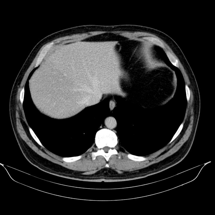 Neuroendocrine tumor of head of pancreas (Radiopaedia 57538-64502 D 13).jpg