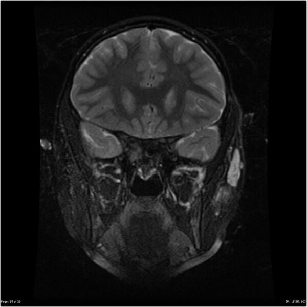 File:Neurofibromatosis type 1 (Radiopaedia 22541-22564 Coronal T2 fat sat 6).jpg