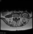 Neurofibromatosis type 2 - cranial and spinal involvement (Radiopaedia 5351-7112 Axial T1 C+ 33).jpg