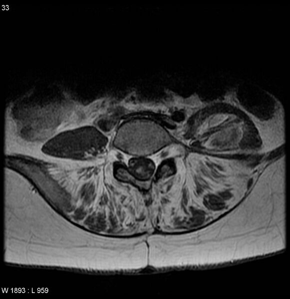 File:Neurofibromatosis type 2 - cranial and spinal involvement (Radiopaedia 5351-7112 Axial T1 C+ 33).jpg