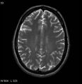 Neurosarcoidosis (Radiopaedia 10930-17204 Axial T2 14).jpg