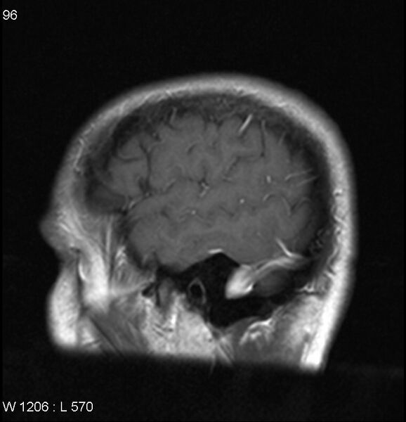 File:Neurosarcoidosis (Radiopaedia 10930-17204 Sagittal T1 C+ 1).jpg