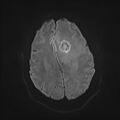 Neurotoxoplasmosis - concentric target sign (Radiopaedia 70644-80784 Axial DWI 15).jpg