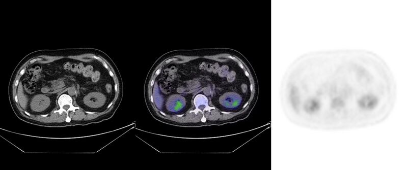 File:Non-Hodgkin lymphoma involving seminal vesicles with development of interstitial pneumonitis during Rituximab therapy (Radiopaedia 32703-33752 ax CT Fus PET 37).jpg