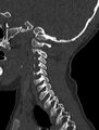 Normal CT cervical spine - pediatric (Radiopaedia 52549-58462 Sagittal bone window 47).jpg