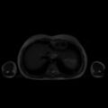 Normal MRI abdomen in pregnancy (Radiopaedia 88001-104541 Axial T2 5).jpg