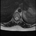 Normal cervical and thoracic spine MRI (Radiopaedia 35630-37156 H 13).png