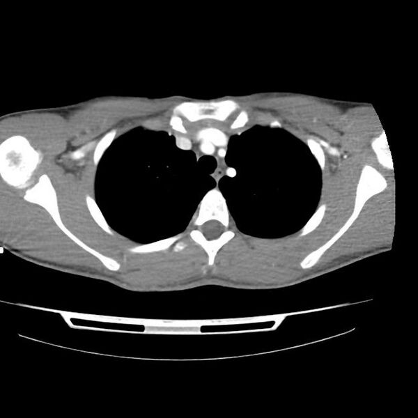 File:Normal dual-phase trauma CT chest,abdomen and pelvis (Radiopaedia 48092-52899 A 12).jpg