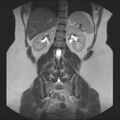 Normal liver MRI with Gadolinium (Radiopaedia 58913-66163 Coronal T2 29).jpg