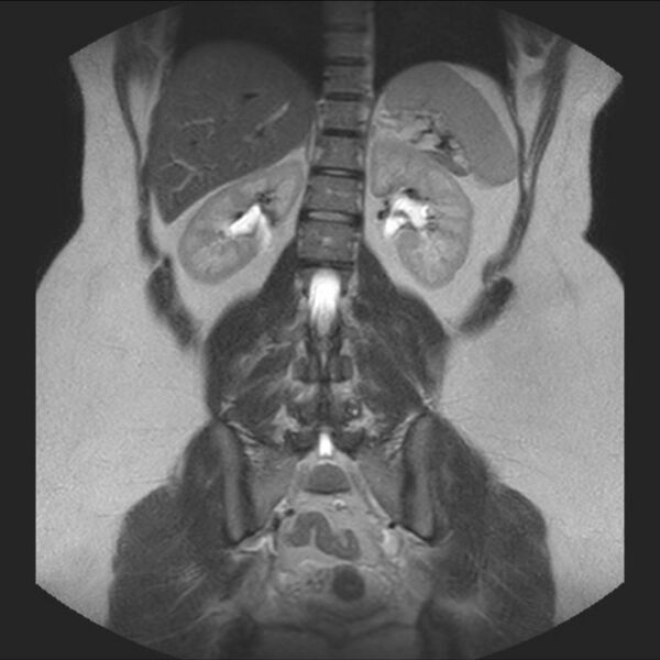 File:Normal liver MRI with Gadolinium (Radiopaedia 58913-66163 Coronal T2 29).jpg