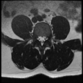 Normal lumbar spine MRI (Radiopaedia 35543-37039 Axial T2 18).png