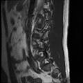 Normal lumbar spine MRI (Radiopaedia 35543-37039 Sagittal T1 11).png