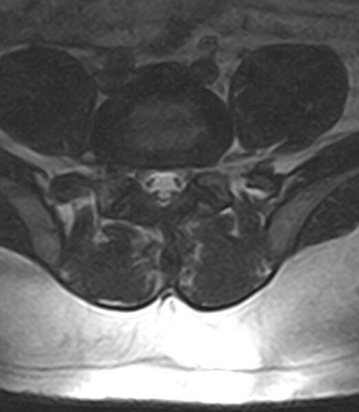 File:Normal lumbar spine MRI - low-field MRI scanner (Radiopaedia 40976-43699 Axial T2 77).jpg