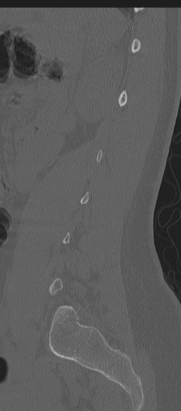 File:Normal lumbosacral CT (Radiopaedia 37923-39867 Sagittal bone window 27).png
