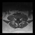 Normal spine MRI (Radiopaedia 77323-89408 Axial T1 14).jpg