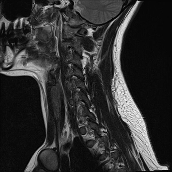 File:Normal trauma cervical spine MRI (Radiopaedia 32130-33071 Sagittal T2 14).jpg