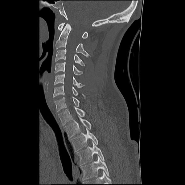 File:Normal trauma spine imaging (Radiopaedia 31753-32686 Sagittal bone window 18).jpg