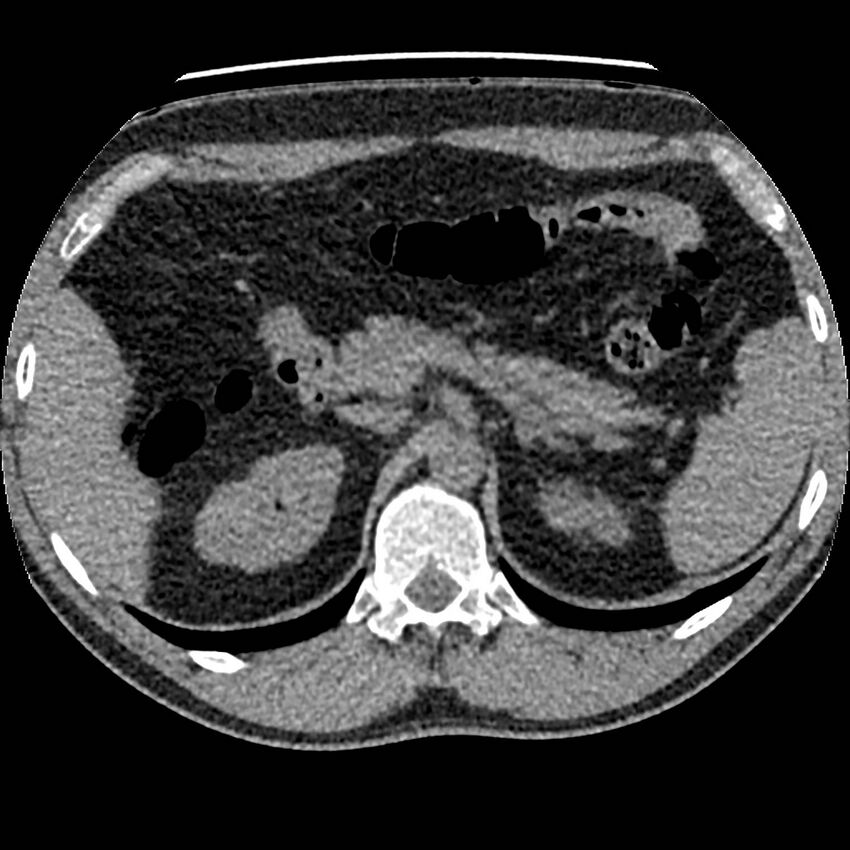 Obstructing ureteric calculus and ureteric anatomy (Radiopaedia 62730-71042 Axial non-contrast 15).jpg