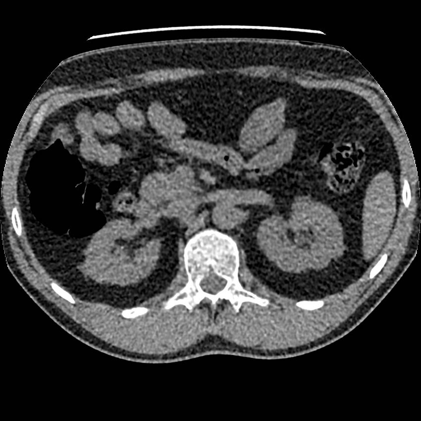 Obstructing ureteric calculus and ureteric anatomy (Radiopaedia 62730-71042 Axial non-contrast 30).jpg