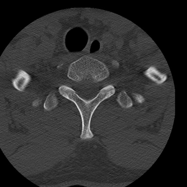 File:Occipital condyle fracture (Radiopaedia 31755-32691 Axial bone window 79).jpg