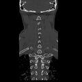 Occipital condyle fracture (Radiopaedia 31755-32691 Coronal bone window 27).jpg