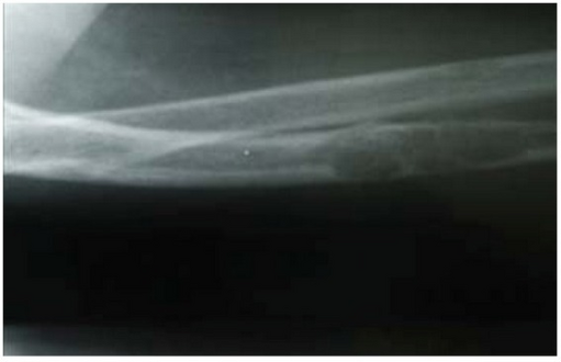 Lateral X-ray of the right radioulna showing osteitis fibrosa cystica lesion of ulna diaphysis with a pathologic fracture