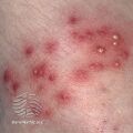 Superficial bacterial folliculitis (DermNet NZ acne-s-folliculitis5).jpg