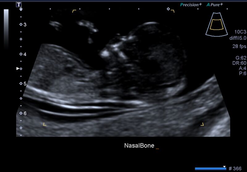 File:1st trimester nuchal-morphology ultrasound (Radiopaedia 44706-48477 General anatomy and NT 3).jpg