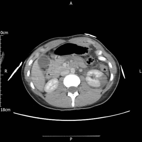 File:AAST grade IV kidney injury with CEUS follow-up (Radiopaedia 72353-82877 Axial C+ portal venous phase 29).jpg