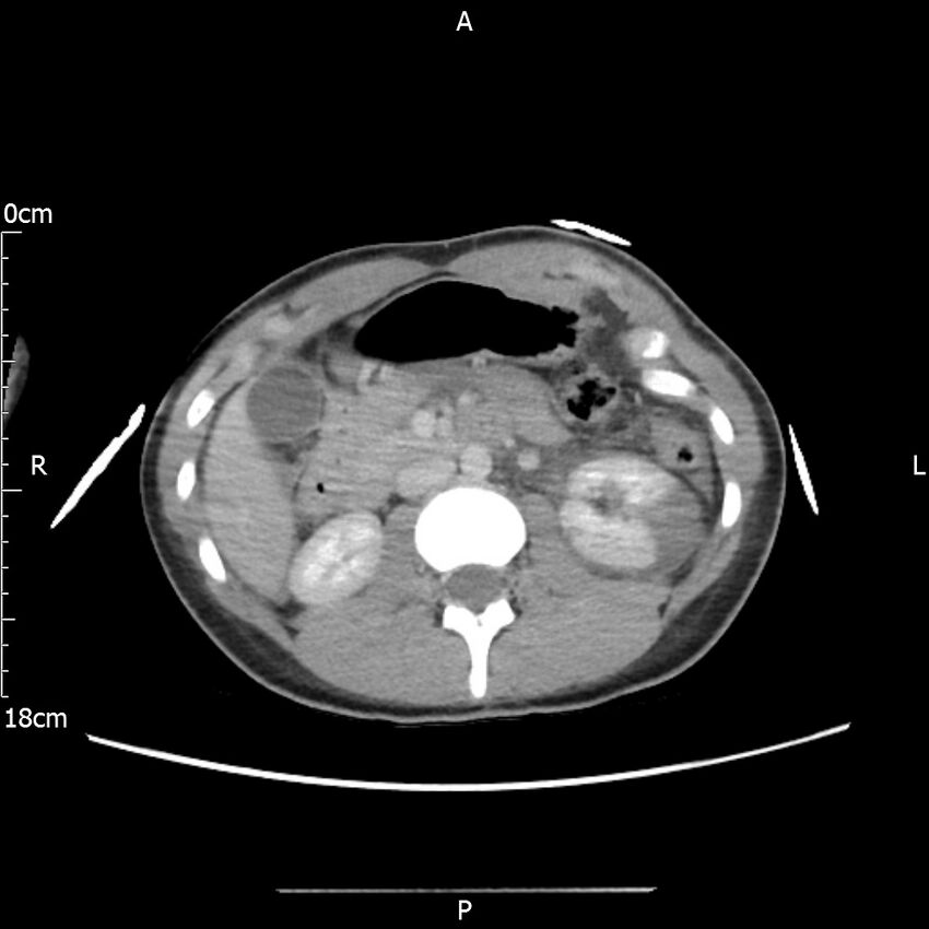 AAST grade IV kidney injury with CEUS follow-up (Radiopaedia 72353-82877 Axial C+ portal venous phase 29).jpg