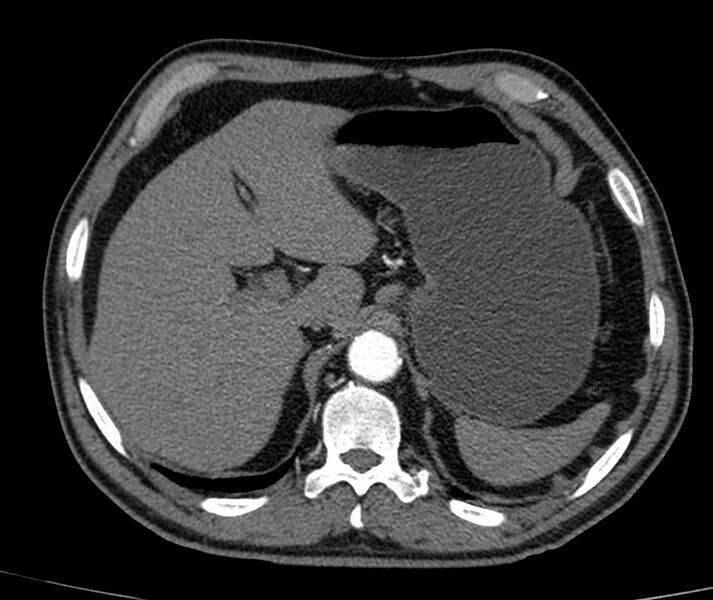 File:Abdominal aortic aneurysm (Radiopaedia 22421-22458 C+ arterial phase 4).jpg