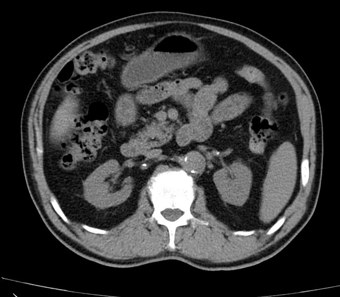 File:Abdominal aortic aneurysm (Radiopaedia 22421-22458 non-contrast 20).jpg