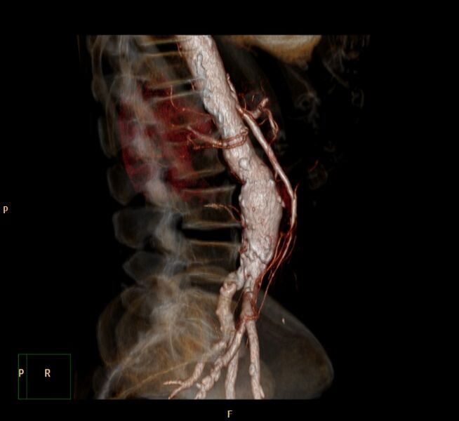 File:Abdominal aortic aneurysm (Radiopaedia 23703-23856 3D 8).jpg