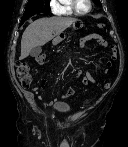 File:Abdominal aortic aneurysm (Radiopaedia 25855-26001 Coronal C+ arterial phase 7).jpg