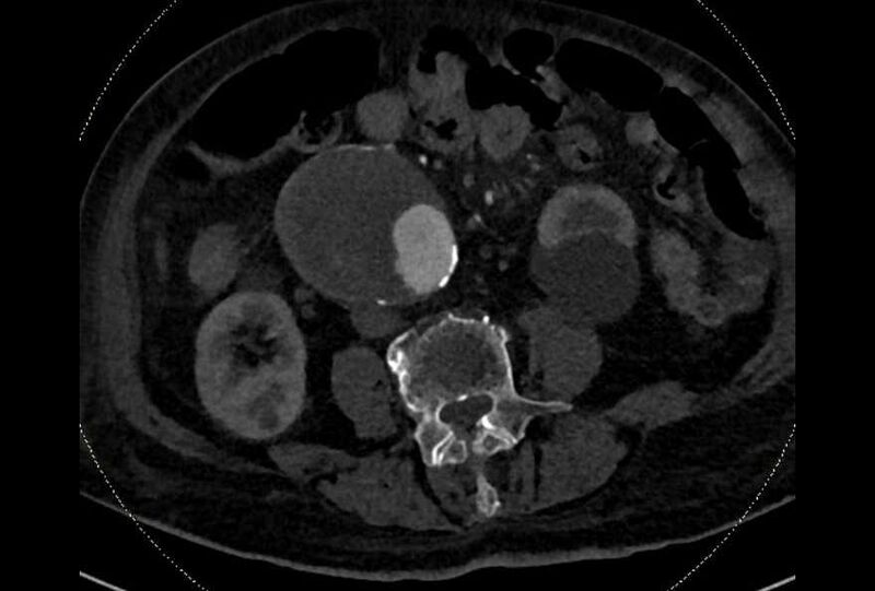 File:Abdominal aortic aneurysm with thrombus fissuration (Radiopaedia 73192-83919 Axial C+ arterial phase 116).jpg