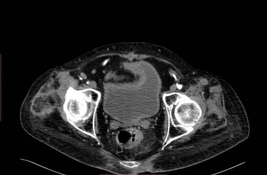 Abdominal aortic interposition tube graft and aneurysm thrombosis (Radiopaedia 71438-81857 Axial C+ arterial phase 221).jpg