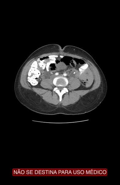 File:Abdominal desmoid tumor (Radiopaedia 44024-47540 Axial C+ arterial phase 21).jpg