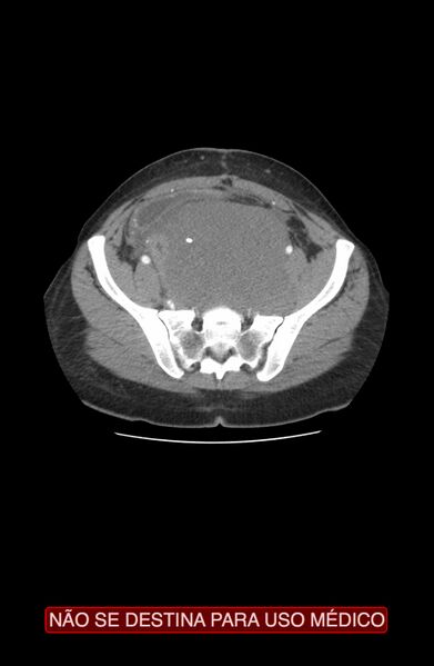 File:Abdominal desmoid tumor (Radiopaedia 44024-47540 Axial C+ arterial phase 34).jpg