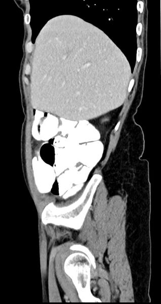 File:Abdominal wall and retroperitoneal tuberculosis (Radiopaedia 88137-104729 Sagittal C+ portal venous phase 121).jpg
