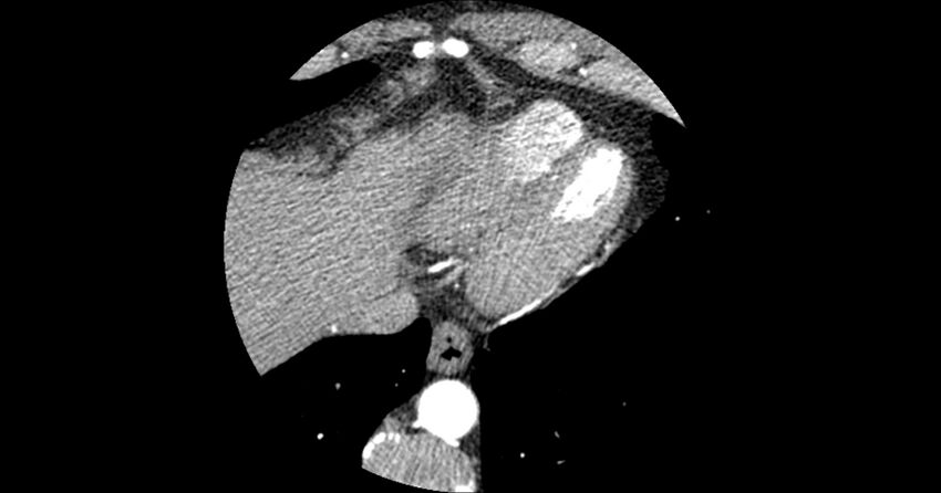 Aberrant left main coronary artery (ALMCA) arising from the right sinus with interarterial course (Radiopaedia 63251-71814 Axial C+ arterial phase 174).JPG