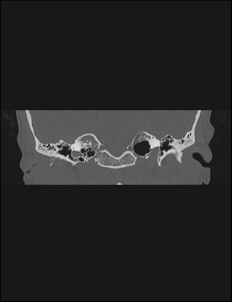 File:Aberrant right internal carotid artery (Radiopaedia 65191-74198 Coronal non-contrast 36).jpg